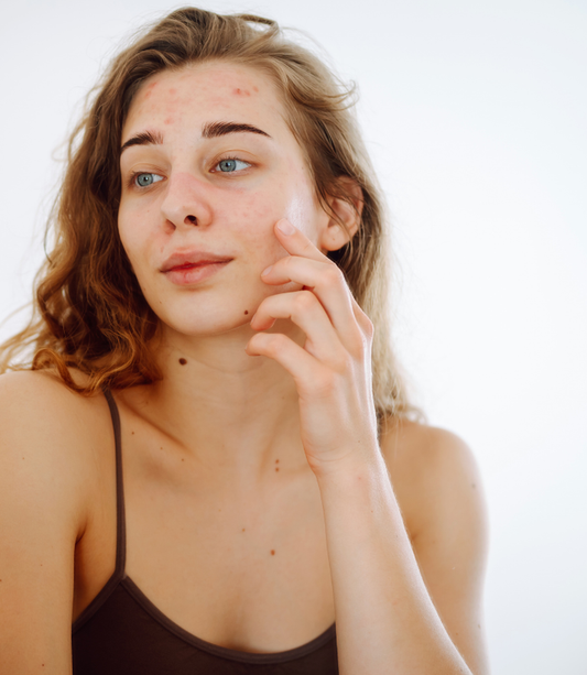 Ultrapure Problem Skin Bundle - Tea Tree Cream, Witch Hazel Toner, Rosehip Oil & Rose Water Toner Mist - Save 10%